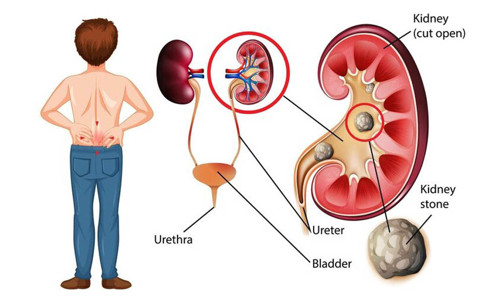 kidney-stones-causes-prevention-treatment